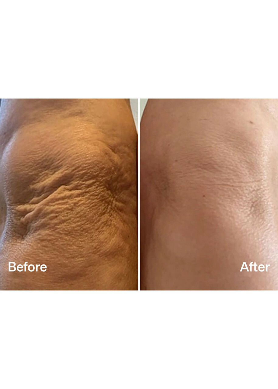Lyma Laser Mist & Glide Refill 60 Days
