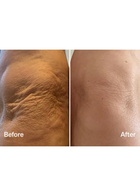 Lyma Laser Mist & Glide Refill 60 Days