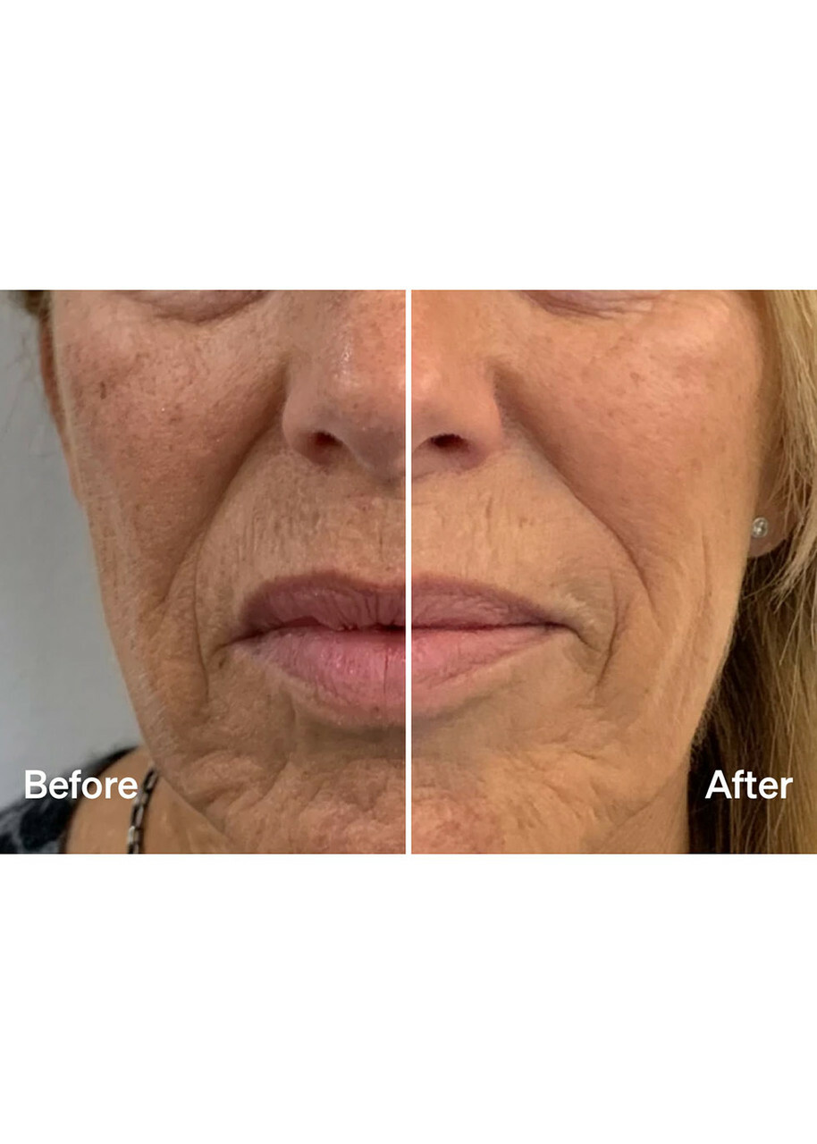 Lyma Laser Mist & Glide Refill 60 Days