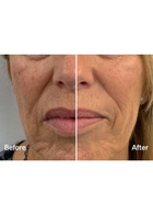 Lyma Laser Mist & Glide Refill 30 Days