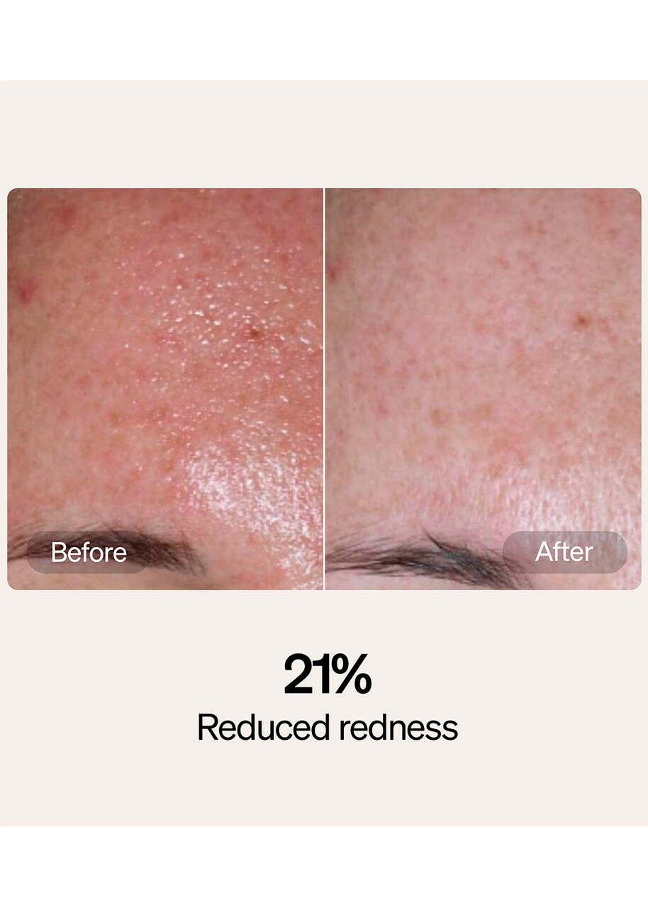 Lyma Serum & Cream Starter Kit, Moisturisers, Reduction in Redness
